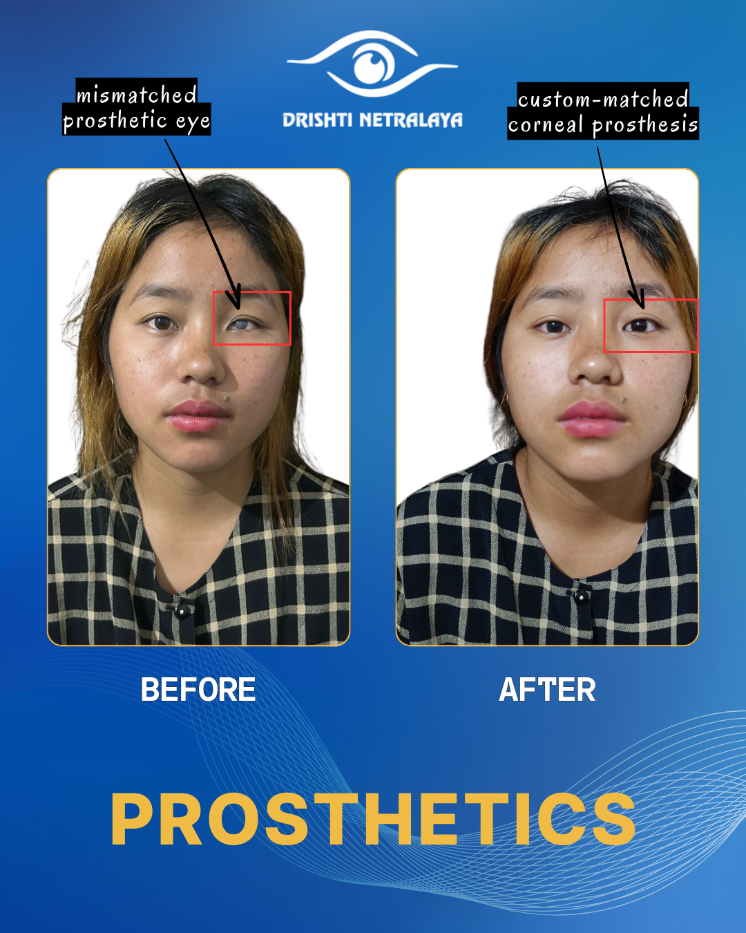 Oculoplasty Treatment in Dibrugarh for Patients from Sivasagar, Charaideo & Lakhimpur