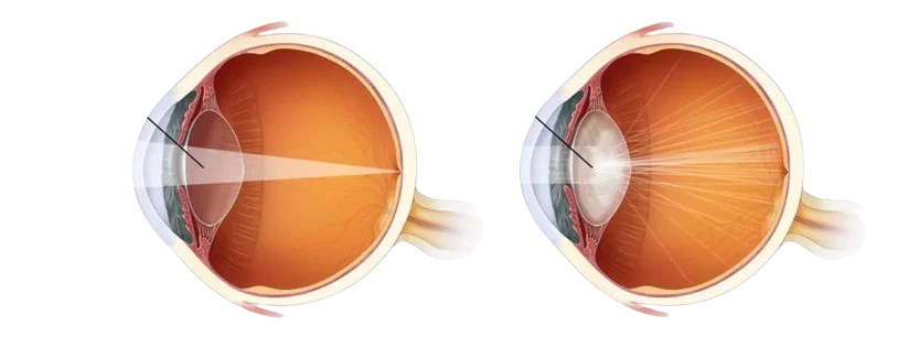 Cataract Surgery Process