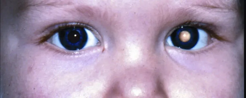 FAQs About Cataracts