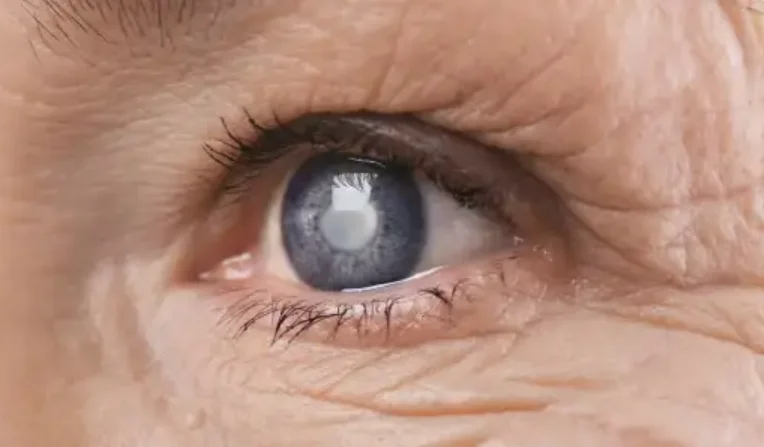 Myths About Cataracts