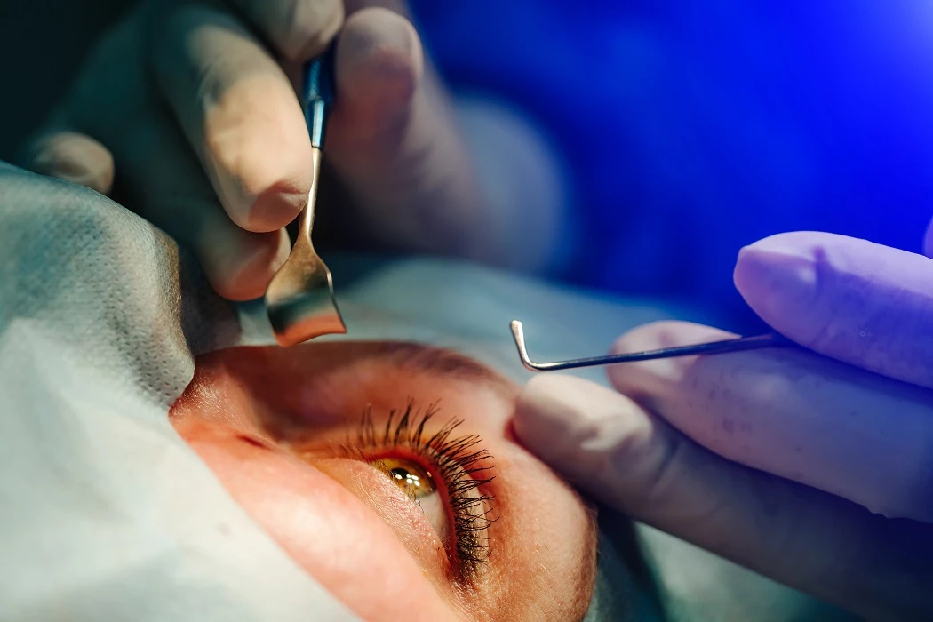 Cataract Surgery through SICS Technique