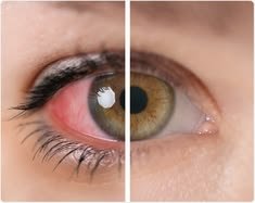 Uveitis Treatment in Dibrugarh
