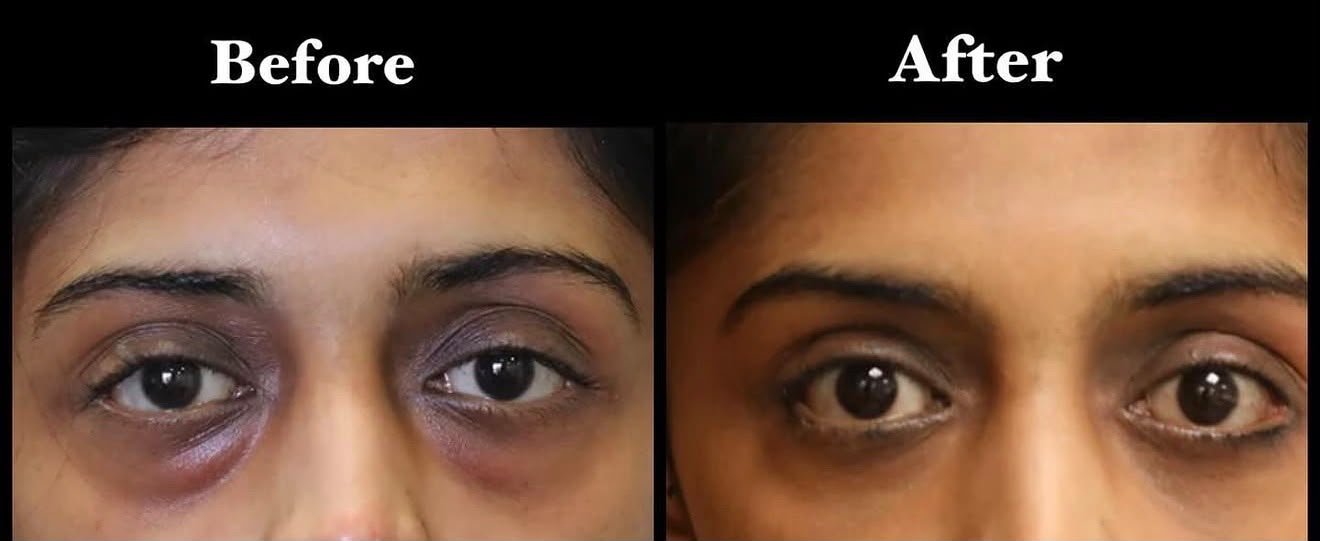 Eyelid Surgery Result 1