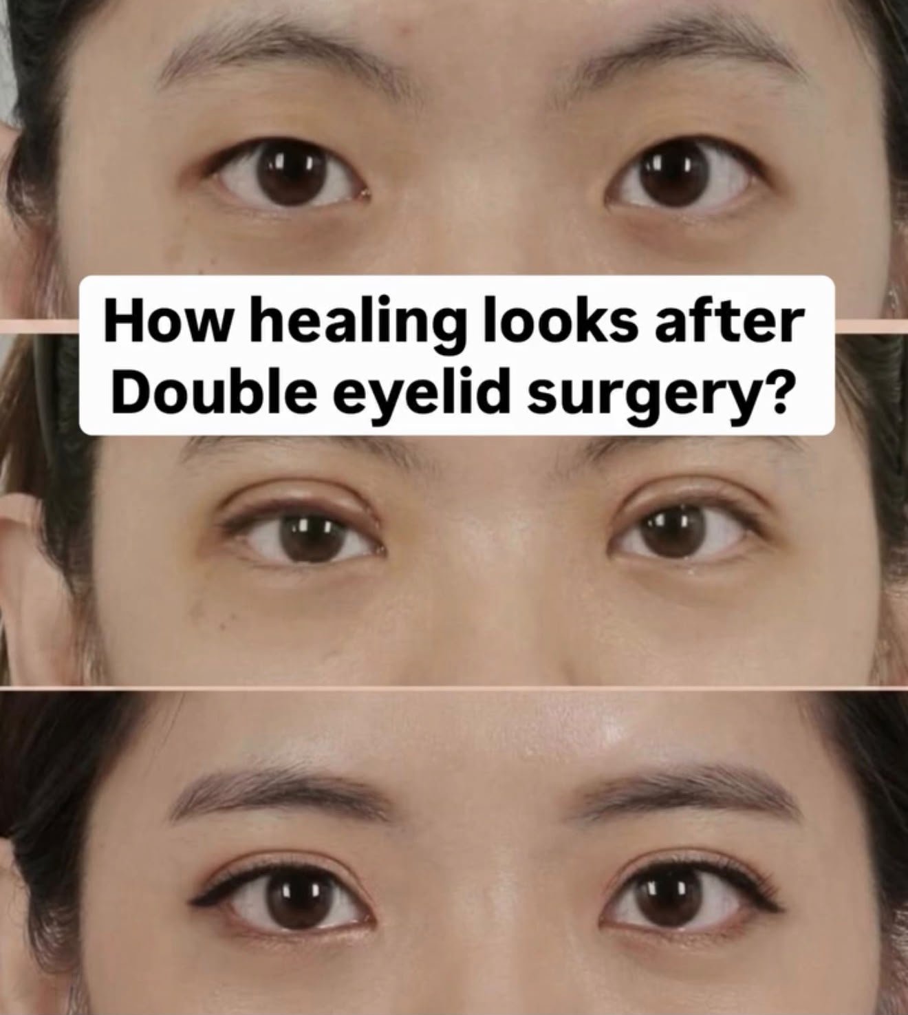 Eyelid Surgery Result 4