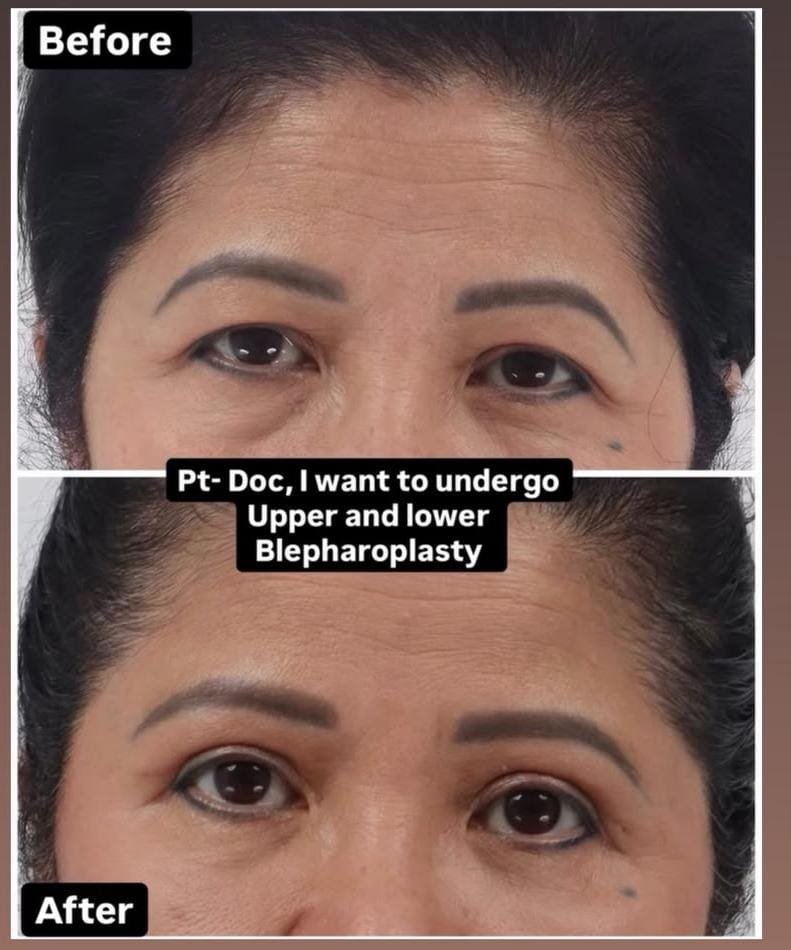 Eyelid Surgery Result 3